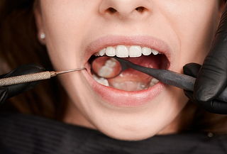 4 Sellantes o 1 Tapadura Blanca Simple + Limpieza Dental 