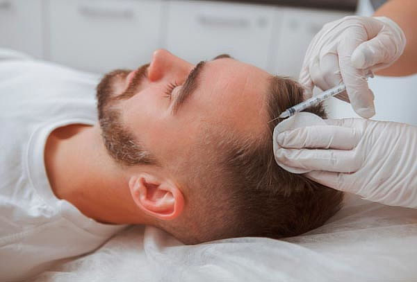 Plasma  Capilar para  Alopecia  y perdida de cabello