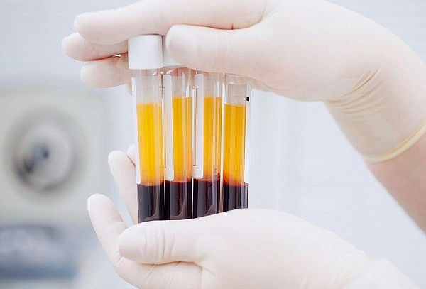 Aplicación de Plasma Rico en Plaquetas Zona a Elección
