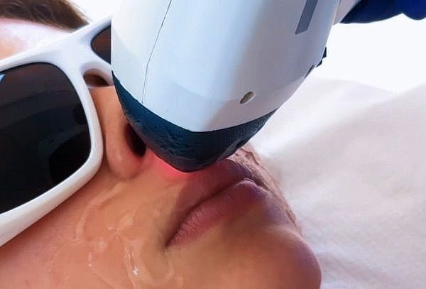 4 o 8 Sesiones: Depilación Láser Diodo ICE 1 Zona elección