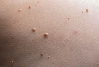 Retiro de Acrocordones en Sunrise, Providencia