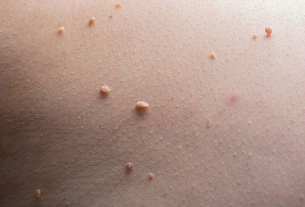 Retiro de Acrocordones en Sunrise, Providencia