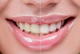 1, 2 o 3 Aplicaciones Blanqueamiento + Limpieza + Profilaxis