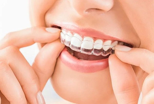 Placa de Relajación para Bruxismo en Dental Magallanes