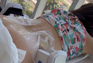 1 o 2 Sesiones de Criolipolisis en Zona a Elección + Ondas 