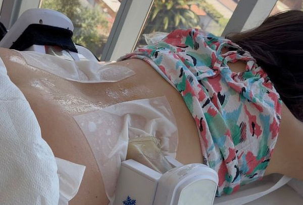 1 o 2 Sesiones de Criolipolisis en Zona a Elección + Ondas 