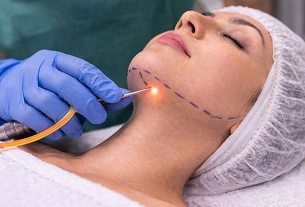 Gift Card de Liposucción de papada + endolaser