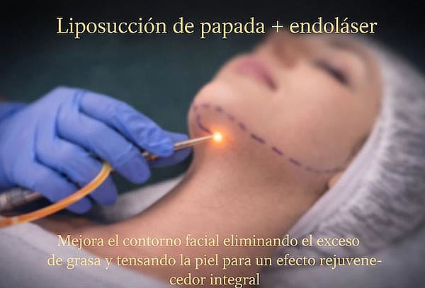 Gift Card de Liposucción de papada + endolaser