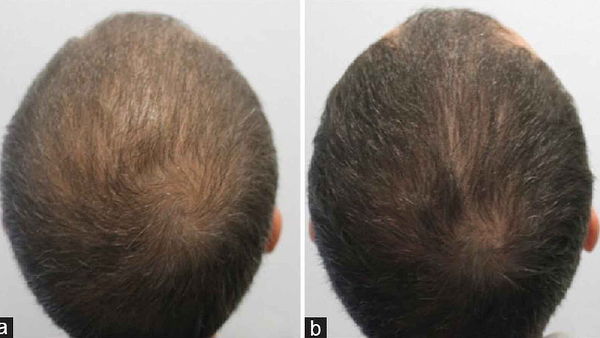 Plasma rico en plaquetas 