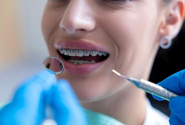 Retiro de ortodoncia + Limpieza + Retenedores 