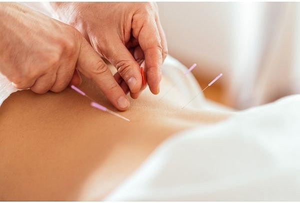 Sesión de acupuntura en Amcci,Santiago