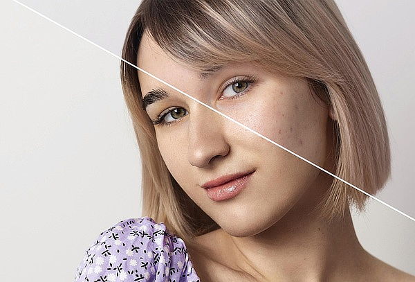 Tratamiento de Acné + Limpieza + Extracción + Mascarilla