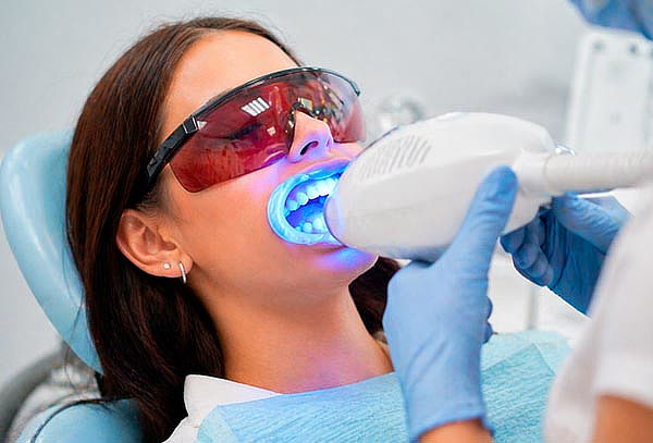 1 Sesión de Blanqueamiento + profilaxis + evaluación