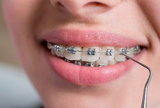 Instalación de ortodoncia Metálicas Dra Yanny Herrera