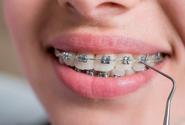 Instalación de ortodoncia Metálicas Dra Yanny Herrera