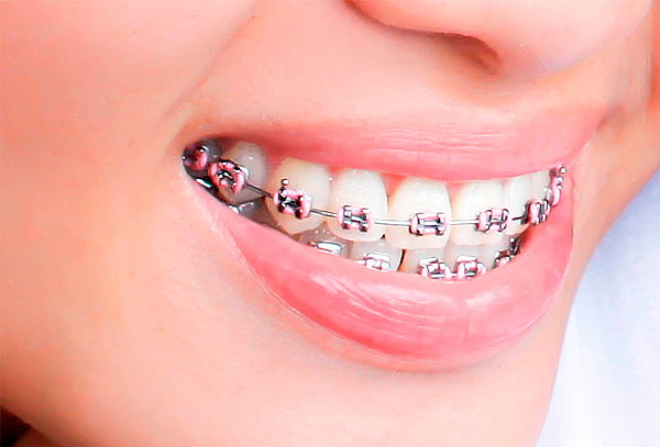 Montaje de Brackets Mini Roth + Limpieza Dental en Chapinero