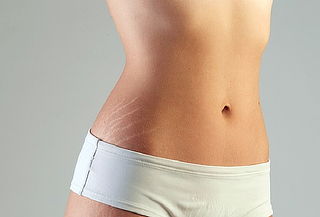 Eliminar estrias con laser precio bogota