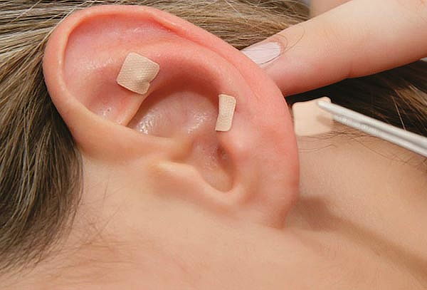 Auriculoterapia para bajar de peso puntos sobresalientes