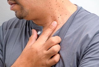 Remoción de Lunares o Verrugas 5mm + Hidratación facial 