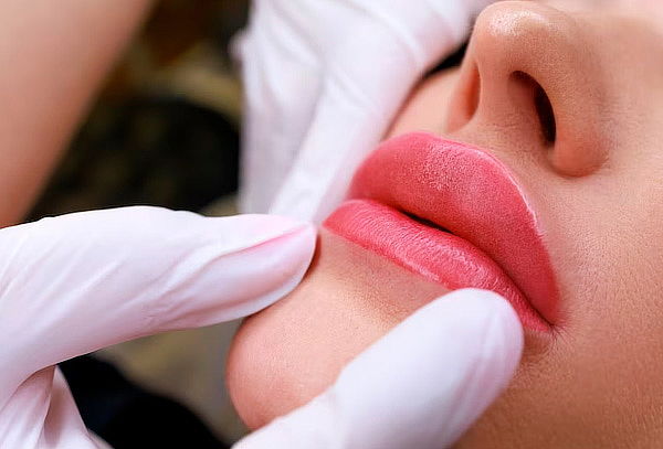 Aumento de Labios con Ácido Hialurónico + Control