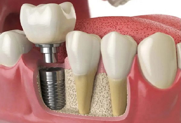 Cirugía de implante dental unitario en titanio 