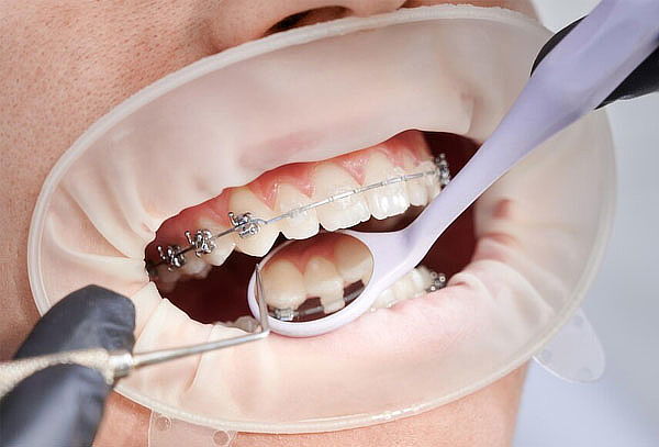 Montaje Brackets MBT + Detartraje + Limpieza Profunda
