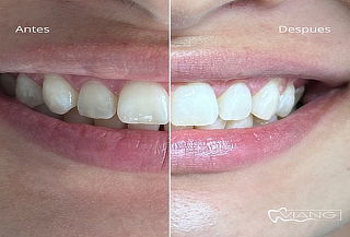 Limpieza dental con ultrasonido + Profilaxis