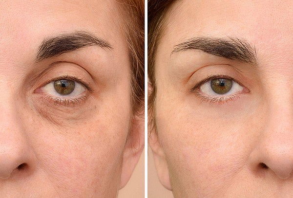 Aclaración y eliminación de Ojeras