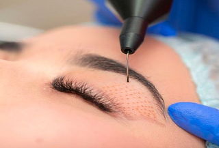 Blefaroplastia Párpados Superiores No Invasivo Fibroblast