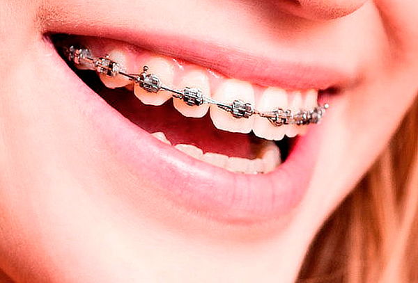 Montaje Brackets + Radiografía + Blanqueamiento Metrópolis