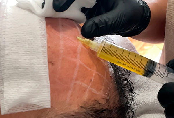 Aplicación Plasma Rico en Plaquetas en Rostro + Cuello