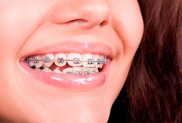 Brackets MBT + Profilaxis + Retenedor Estético en Galerías