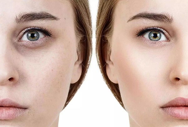 Corrección de ojeras Acido Hialurónico + Hidratación + LED