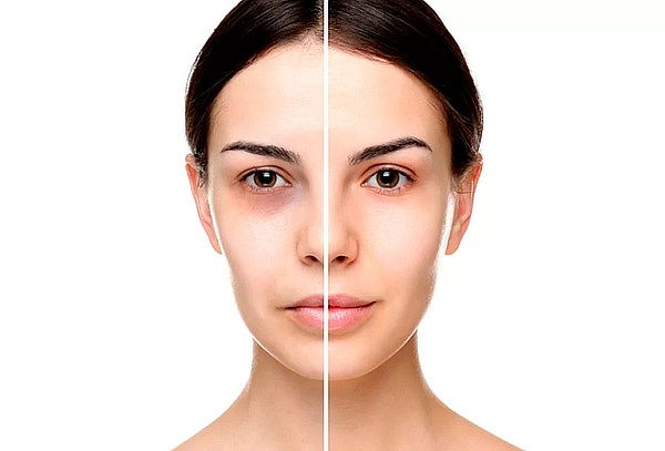 Corrección de ojeras Acido Hialurónico + Hidratación + LED