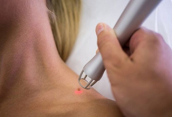 Remoción de hasta 5 lunares o verrugas con Plasmapen max 3mm