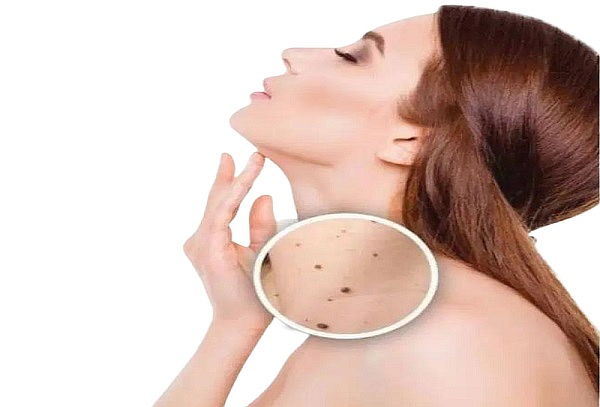  Remoción de 1 hasta 12 lunares max 4 mm - Laser Fibroblast