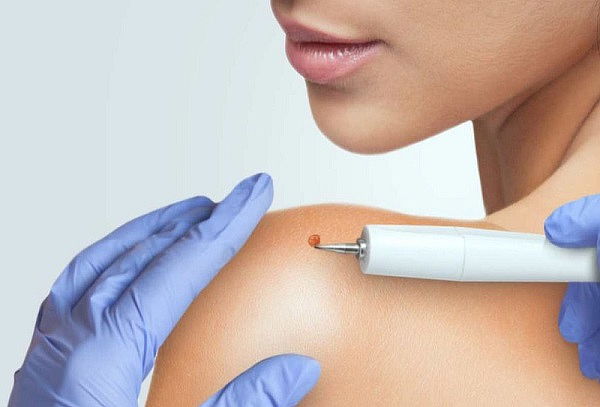  Remoción de 1 hasta 12 lunares max 4 mm - Laser Fibroblast
