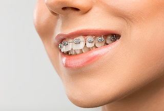 Retiro De Brackets + Profilaxis + Detartraje + Regalo