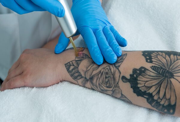 Remocion de Tatuaje con Laser