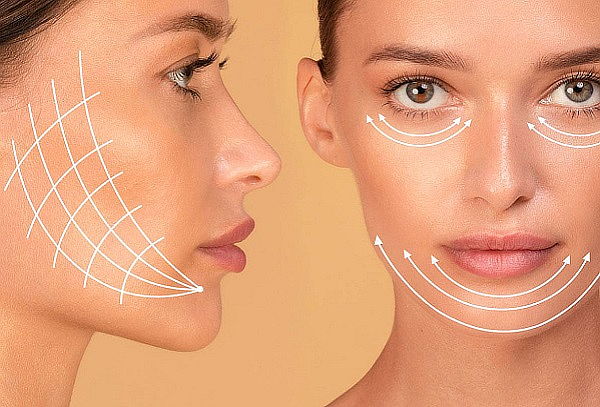 2 - 4 o 6 Hilos tensores de Colágeno rejuvenecimiento facial