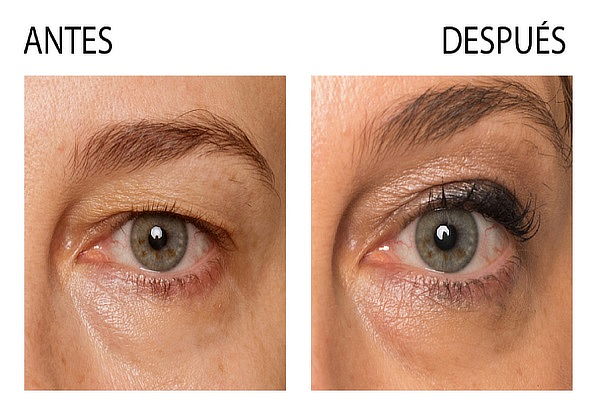 1 Sesión Blefaroplastia Párpados Superiores NO invasivo 