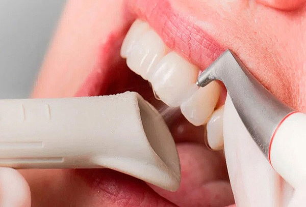 Limpieza Dental con Profijet + Profilaxis