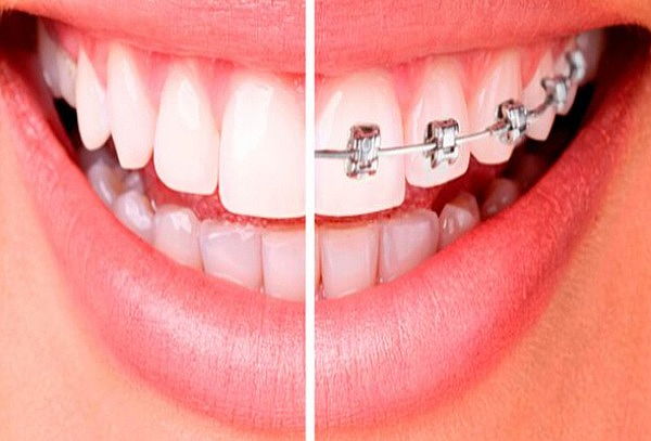Retiro de Ortodoncia + Pulido Dental