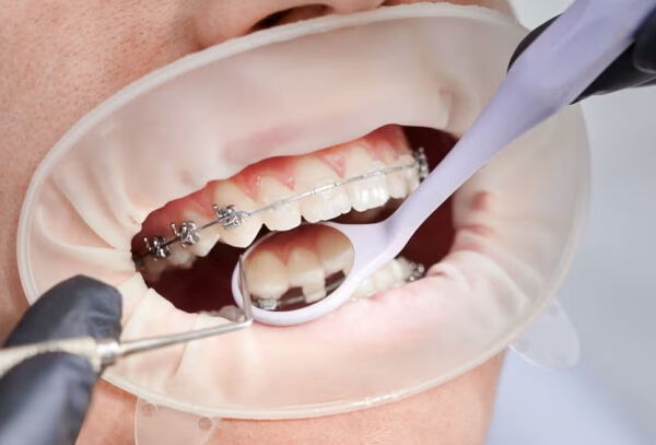 Retiro de Ortodoncia + Pulido Dental
