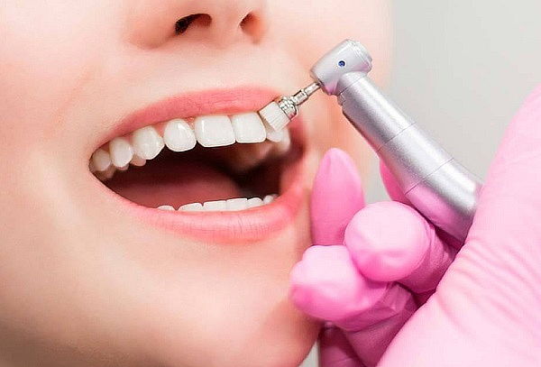 Limpieza dental + Desmanchado + Pulido + Profilaxis