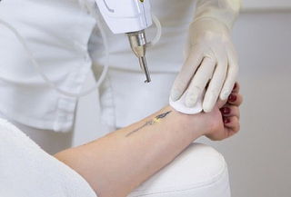 Remoción de Tatuajes Laser ND Yag Q-swichet 3cm, 5cm