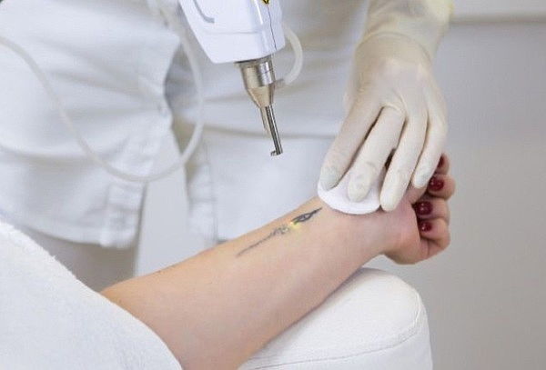 Remoción de Tatuajes Laser ND Yag Q-swichet 3cm, 5cm