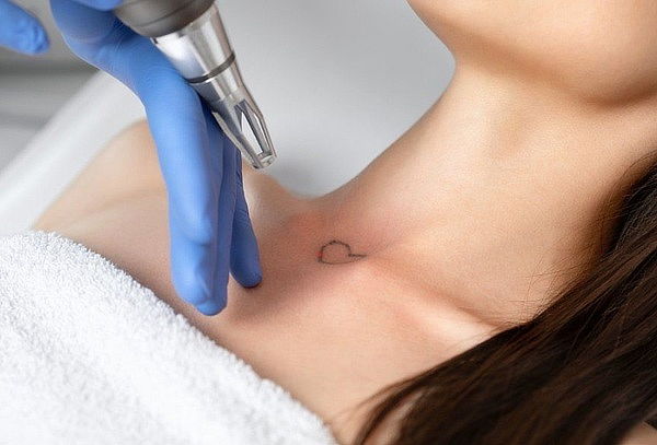 Remoción de Tatuajes Laser ND Yag Q-swichet 3cm, 5cm