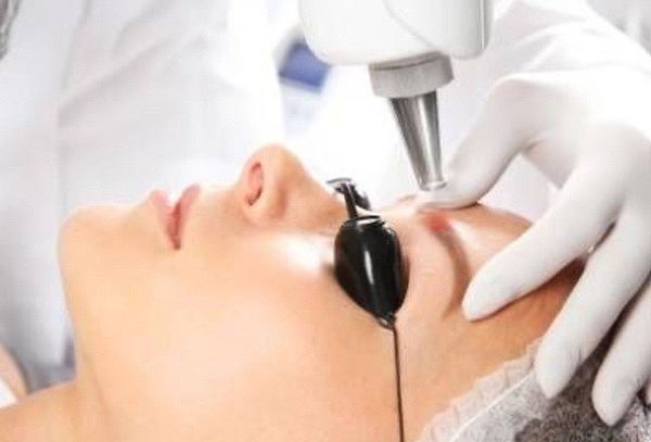 2 Sesiones Remoción Laser de Cejas Tatuadas 