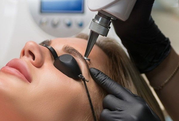 2 Sesiones Remoción Laser de Cejas Tatuadas 
